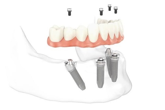 インプラント治療 - 歯科ホワイトピアノ（熊本市北区）